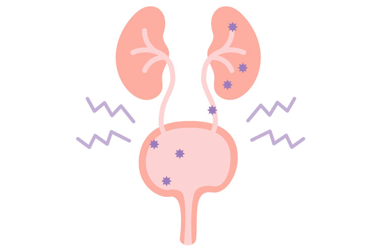 膀胱炎のイメージ画像