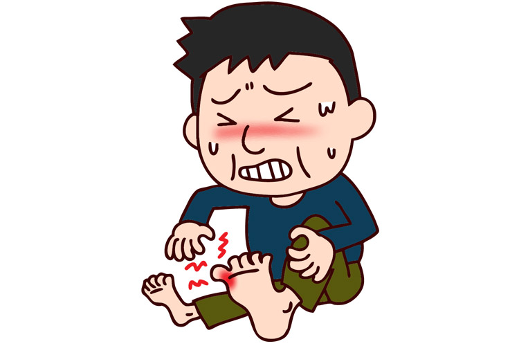 高尿酸血症のイメージ画像